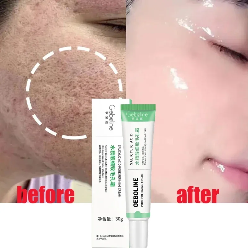 Skincare Salicylic Acid - ครีมลดรูขุมขนกรดซาลิไซลิกกำจัดรูขุมขนกว้างกำจัดสิวหัวดำกระชับผิวหน้าเรียบเนียนผลิตภัณฑ์ดูแลเกาหลี