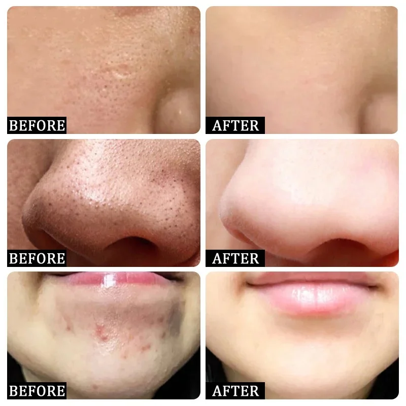 Salicylic Acid Pore Clearing C - Skincare Salicylic Acid บทวิจารณ์และราคา