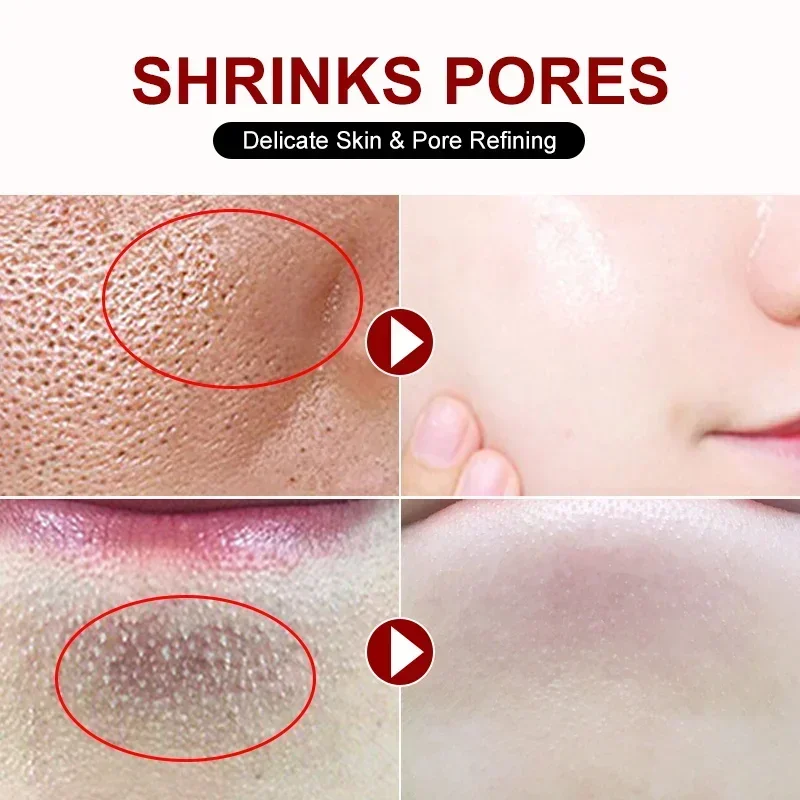 ครีมลดรูขุมขนกรดซาลิไซลิกกำจัด - Skincare Salicylic Acid บทวิจารณ์และราคา