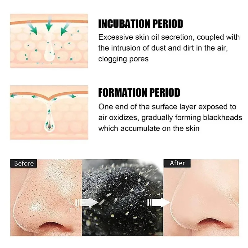 แผ่นมาส์กกำจัดสิวเสี้ยน 10/150 - Skincare Finally Found You บทวิจารณ์และราคา